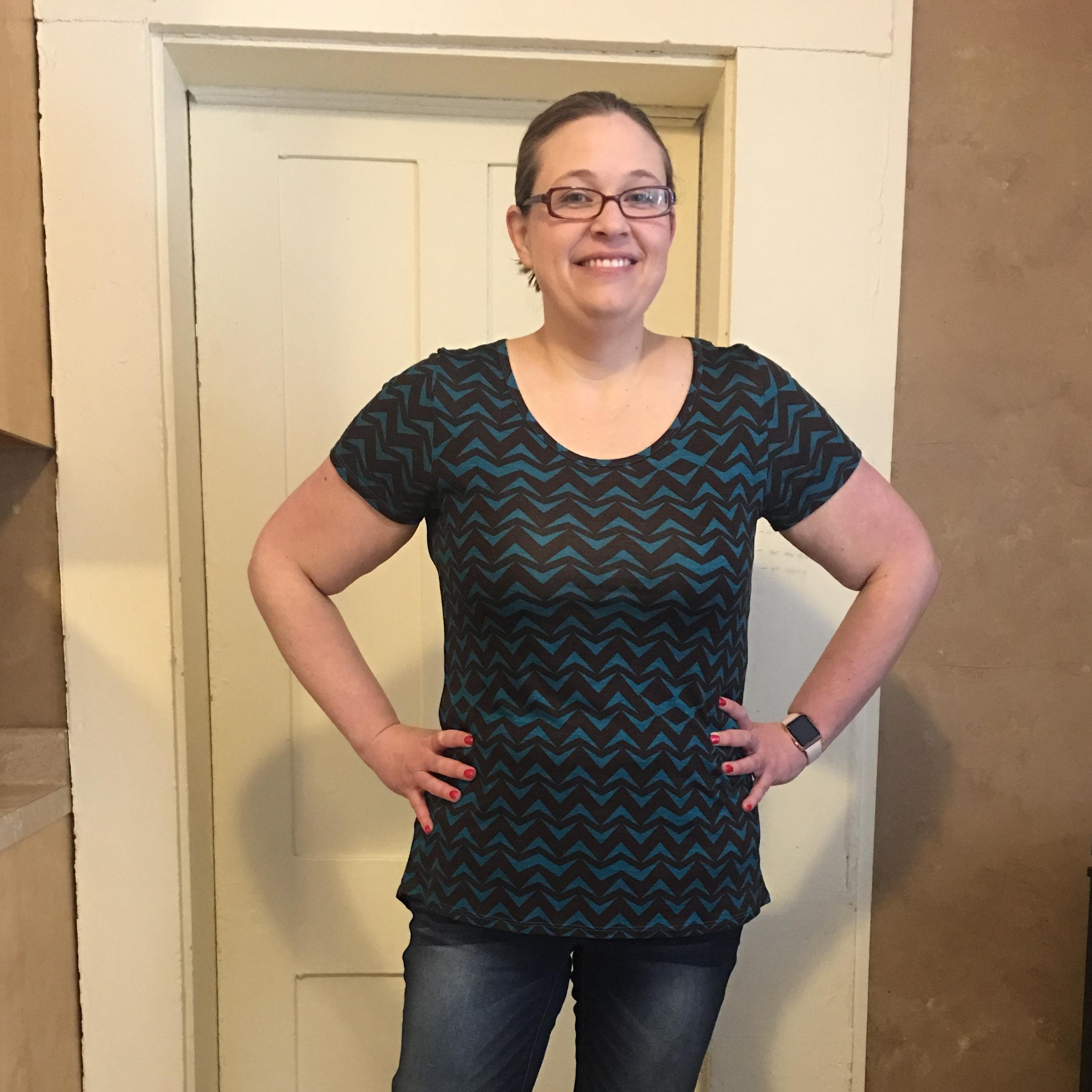 Vertical Sleeve Gastrectomy (VSG) Also known as Sleeve Gastrectomy