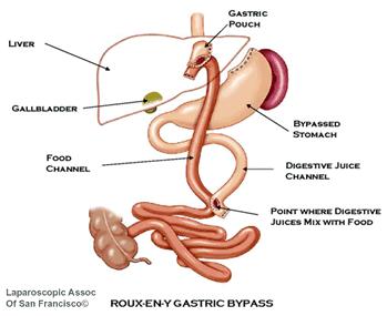 gastric bypass