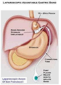 weight loss surgery