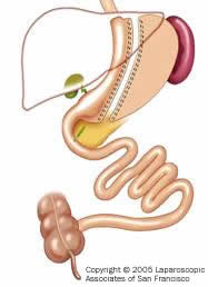 Vertical Sleeve Gastrectomy