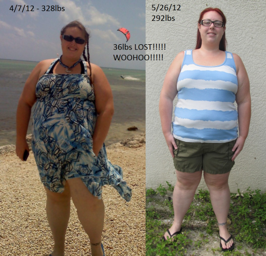 Vertical Sleeve Gastrectomy Forum (VSG)