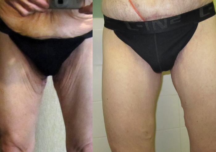 http://images.obesityhelp.com/uploads/profile/777923/albums/101495/thigh%20comp.jpg