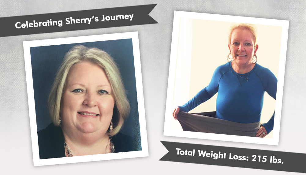 Before & After VSG (Vertical Sleeve Gastrectomy) with Sherry, losing