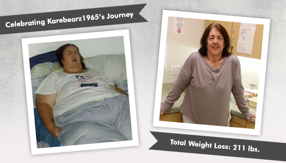 Before & After RNY with Karebearz1965, losing 211 pounds! ObesityHelp