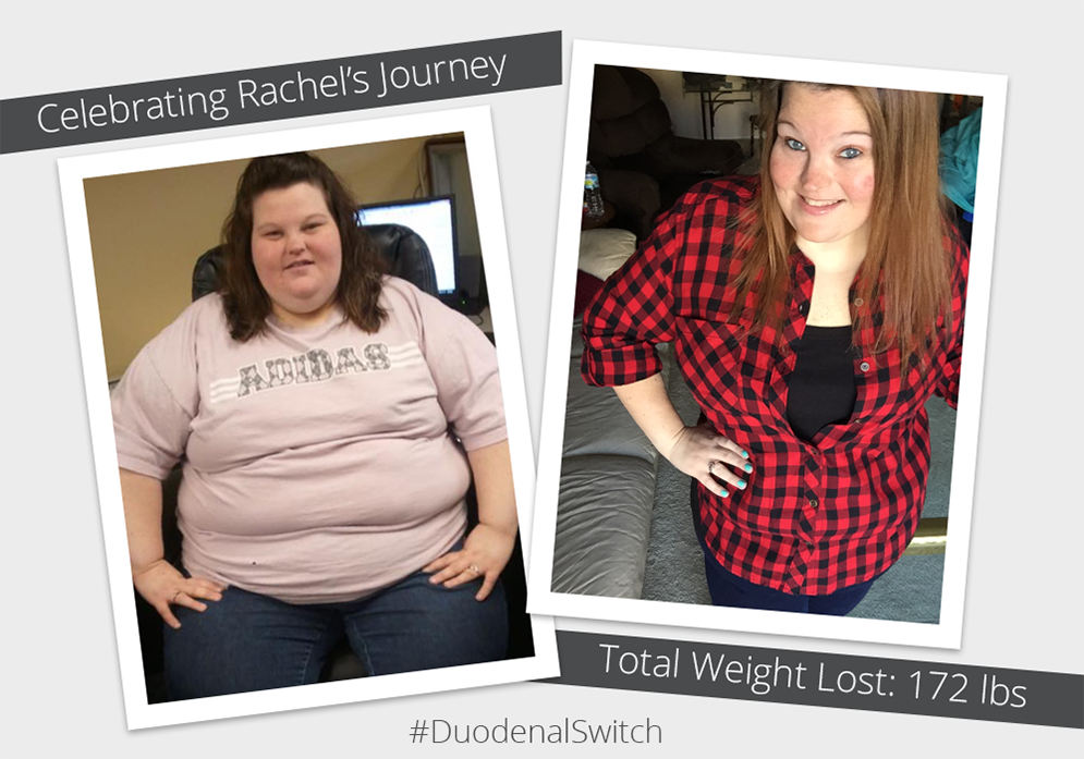 Before & After DS with Rachel! ObesityHelp