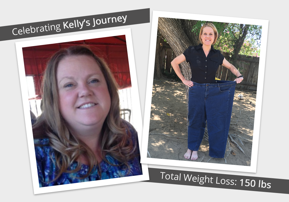 Before & After RNY with Kelly : ObesityHelp