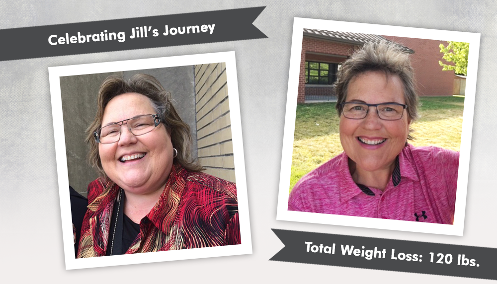 Before & After Revision from LapBand to Gastric Bypass with Jill