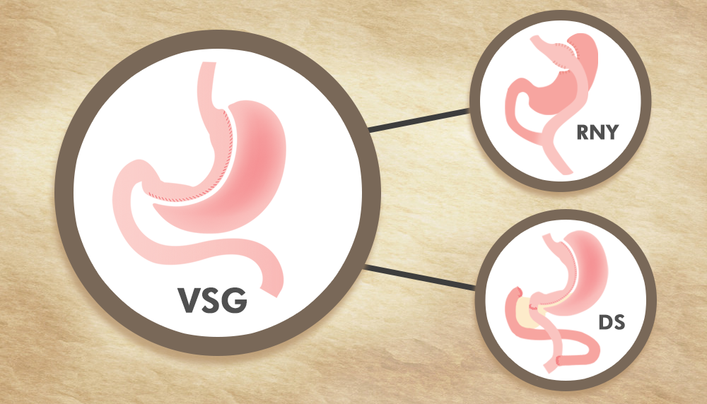 What to Expect from a VSG Revision to RNY or DS ObesityHelp