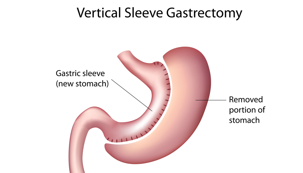What Is Vertical Sleeve Gastrectomy? ObesityHelp