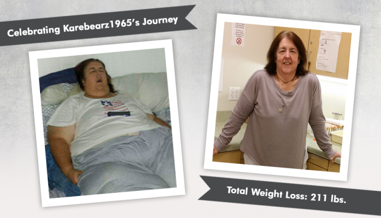 Before After RNY Gastric Bypass With Karebearz1965