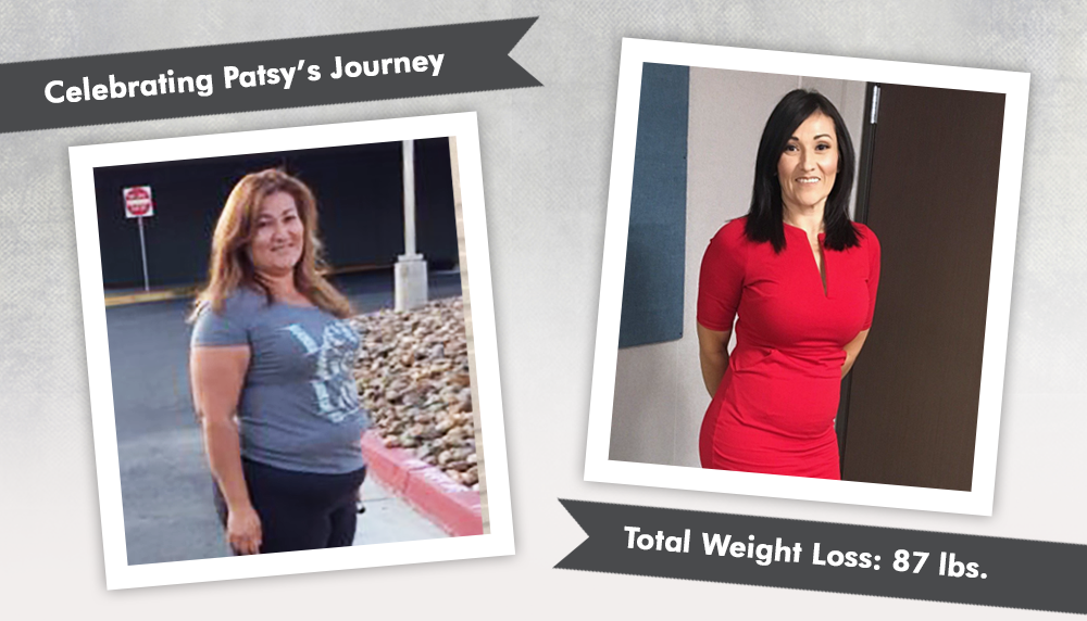 Before & After RNY with Patsy, losing 87 pounds! : ObesityHelp