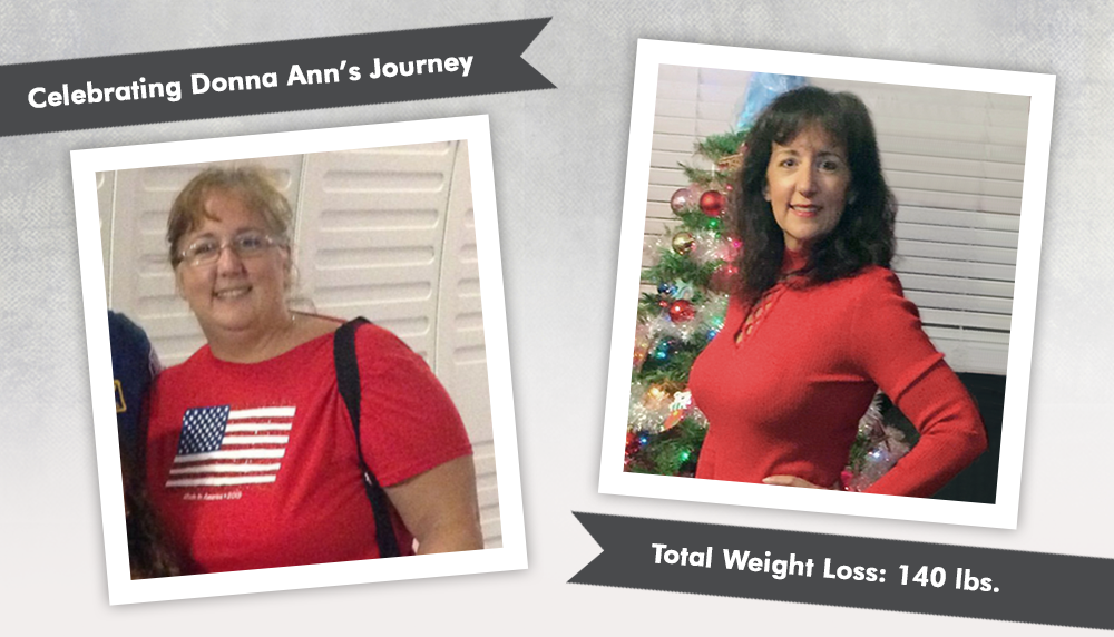 Before & After VSG with Donna Ann, losing 140 pounds ObesityHelp