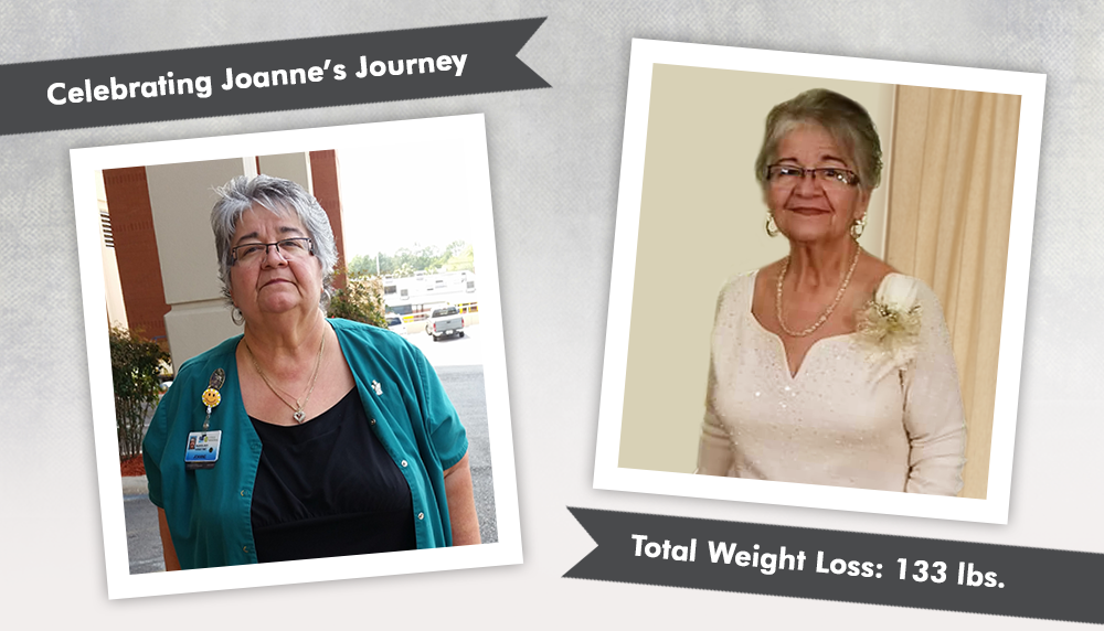Before & After RNY with Joanne, losing 133 lbs! ObesityHelp