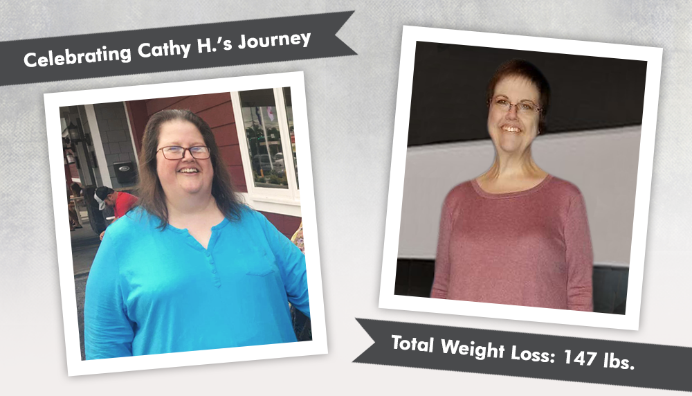 Before & After VSG with Cathy H., losing 147 pounds! ObesityHelp