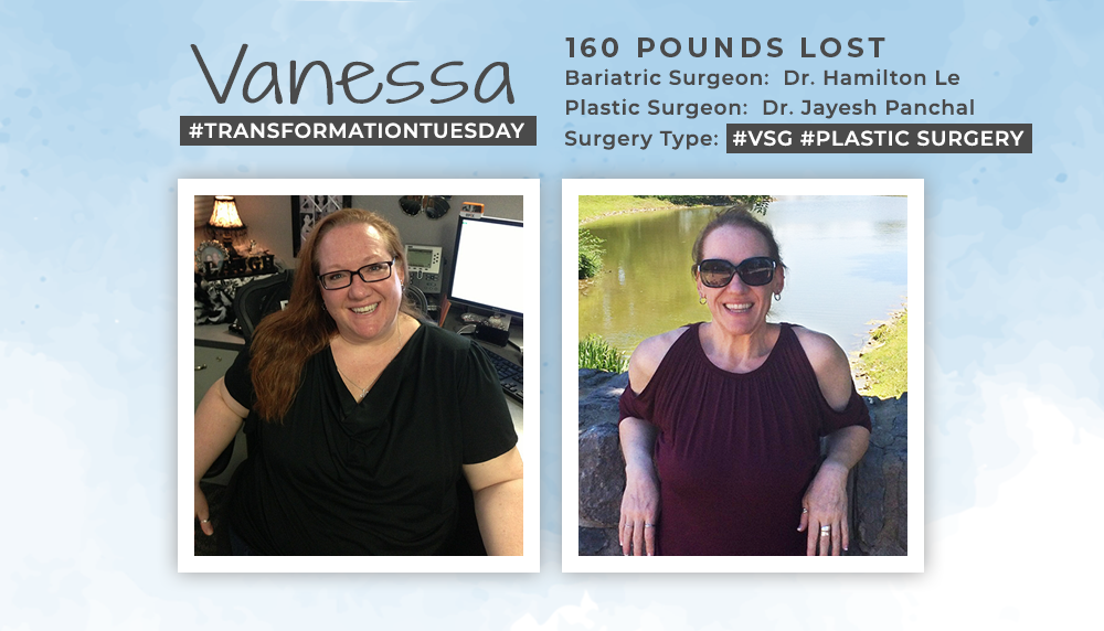 Before & After VSG and Plastic Surgery with Vanessa, losing 160 lbs