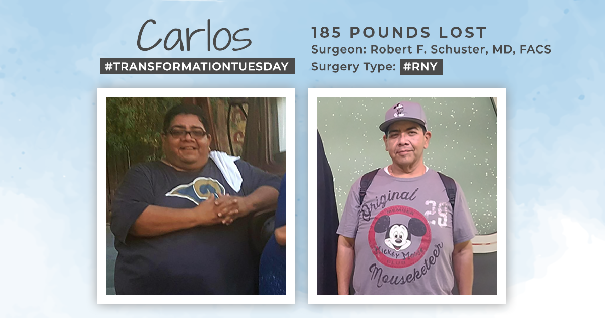 Before & After RNY with Carlos, down 185 pounds! : ObesityHelp