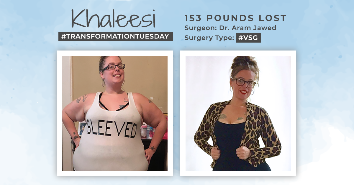 Before & After VSG with Khaleesi Sleeved, down 153 pounds! ObesityHelp