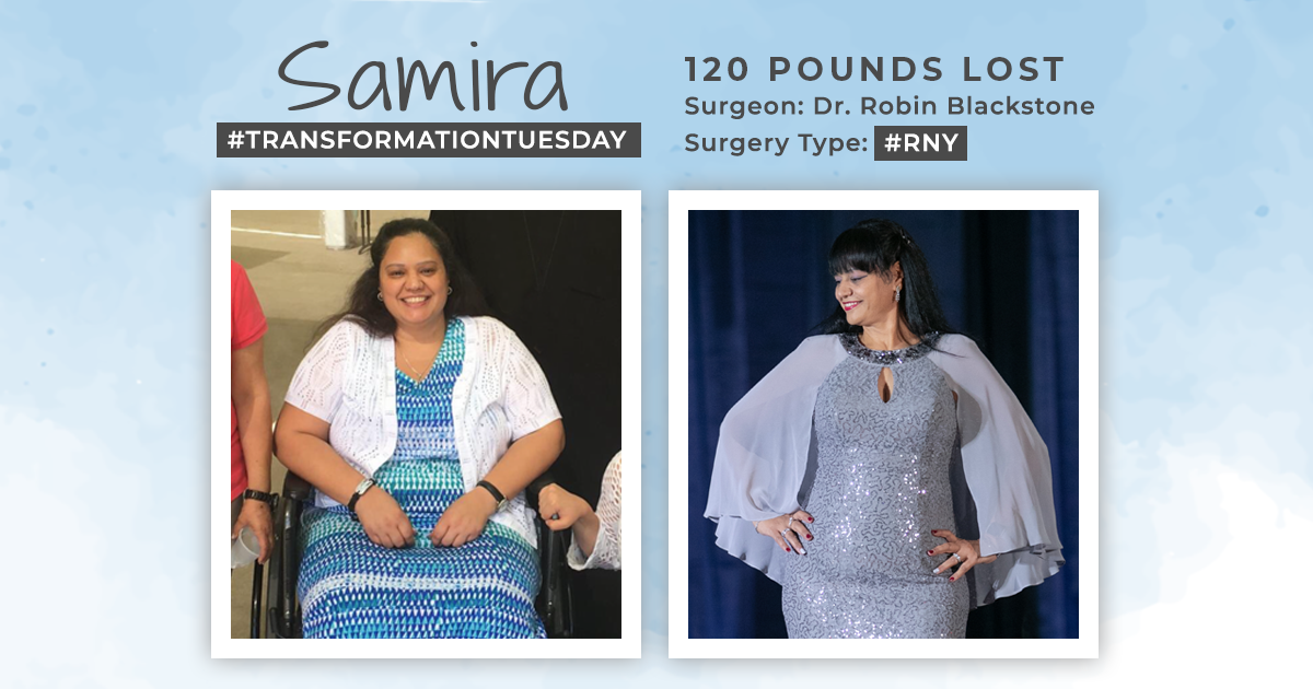 Before & After RNY with Samira, down 120 pounds! : ObesityHelp
